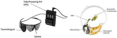 The Argus-II Retinal Prosthesis Implantation; From the Global to Local Successful Experience